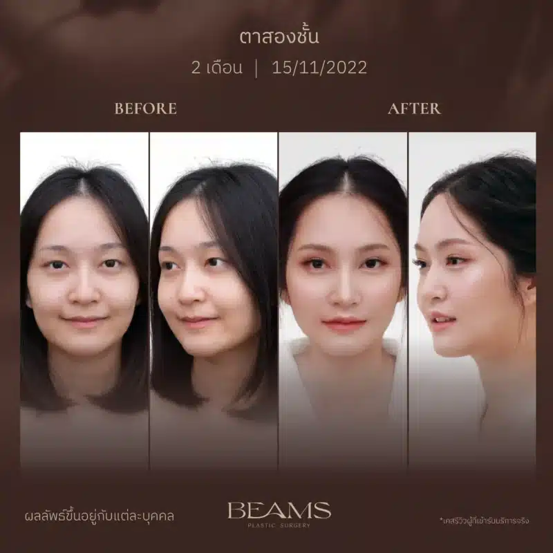 ผลลัพธ์คุณไข่มุก ศัลยกรรมตา 2 ชั้น