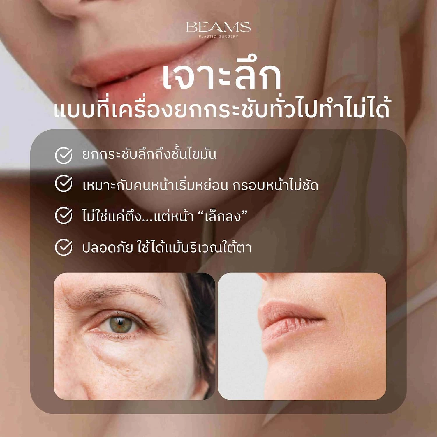 EndoliftX ต่างกับเครื่องยกกระชับทั่วไปยังไง
