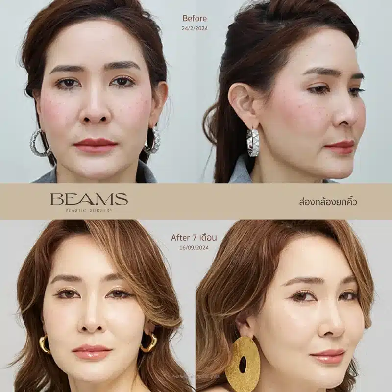 ผลลัพธ์การยกคิ้วส่องกล้อง