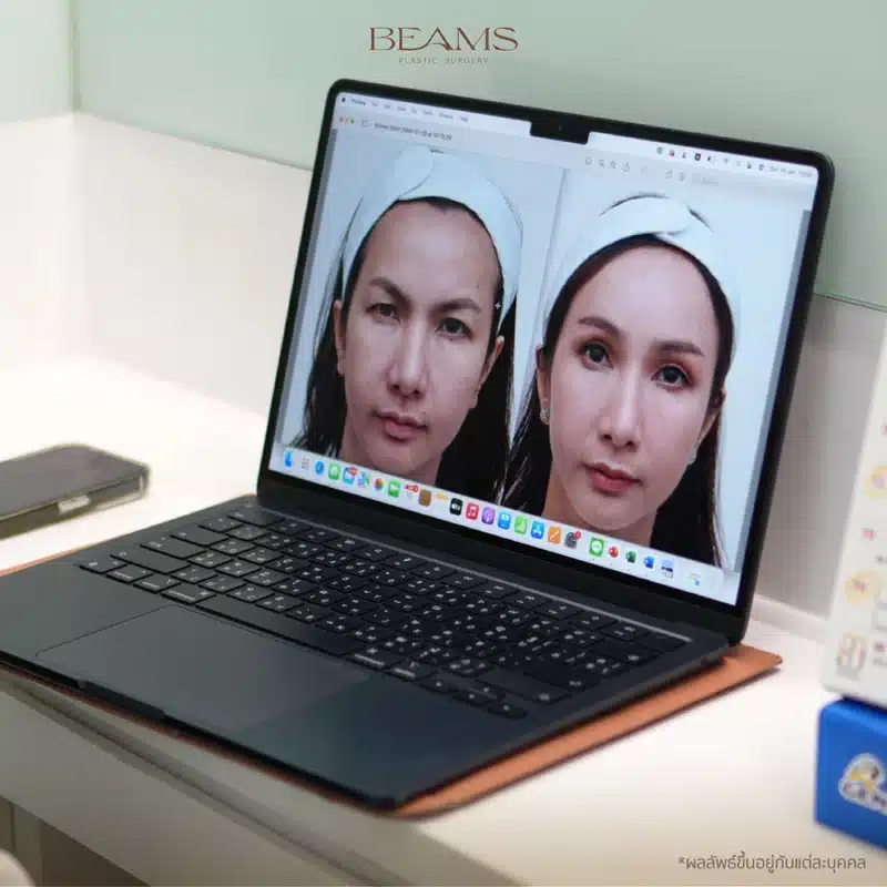 Subbrow lift คืออะไร