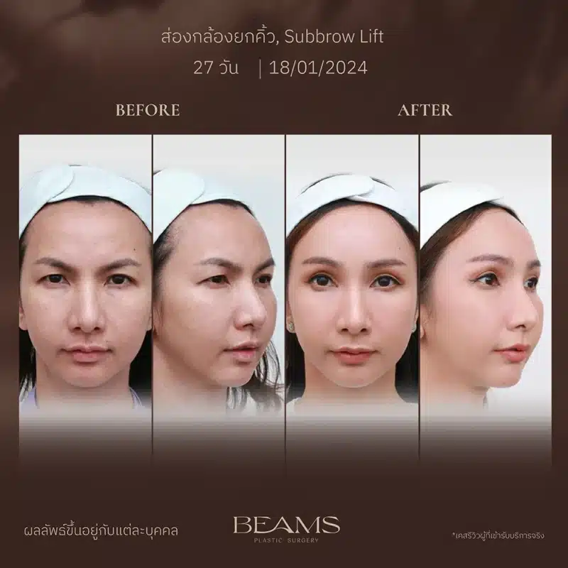ผลลัพธ์ ของSubbrow lift