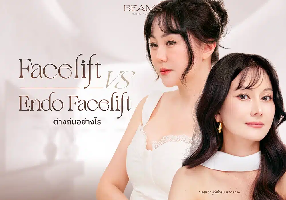 Face lift VS Endo face lift