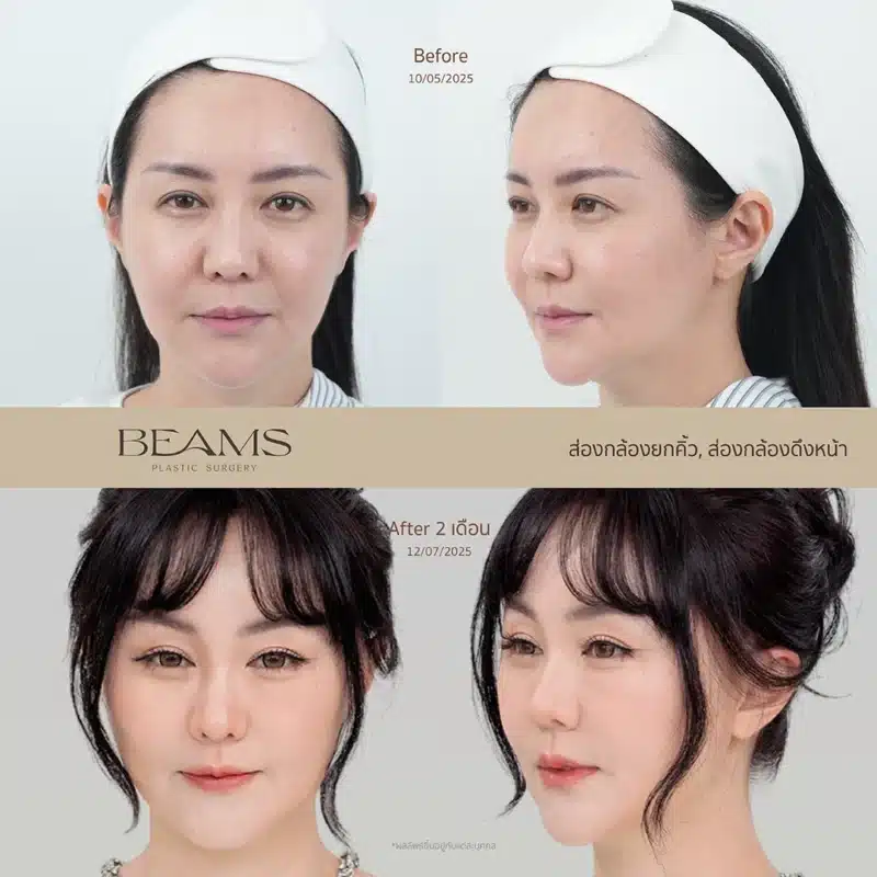 ผลลัพธ์ส่องกล้องดึงหน้า คุณอาเล็ค