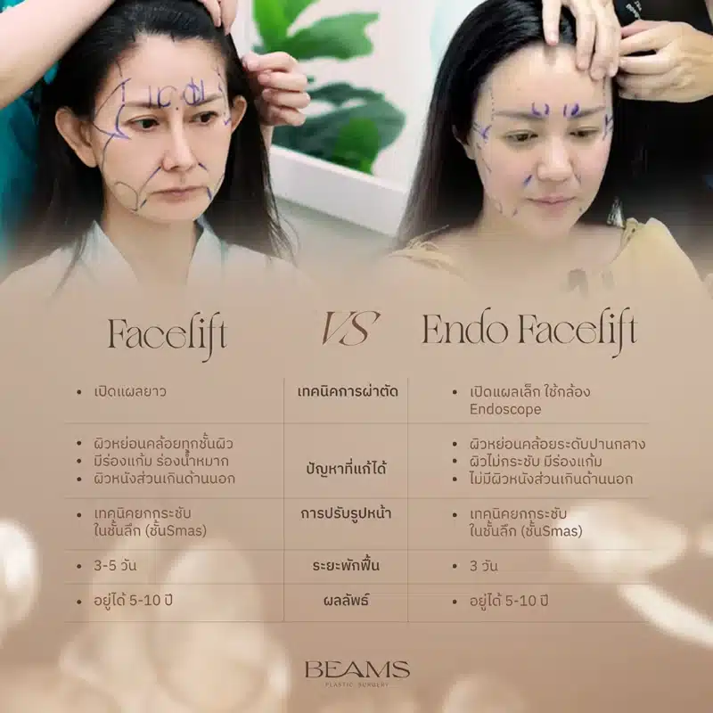 Facelift VS Endo Facelift ต่างกันอย่างไร