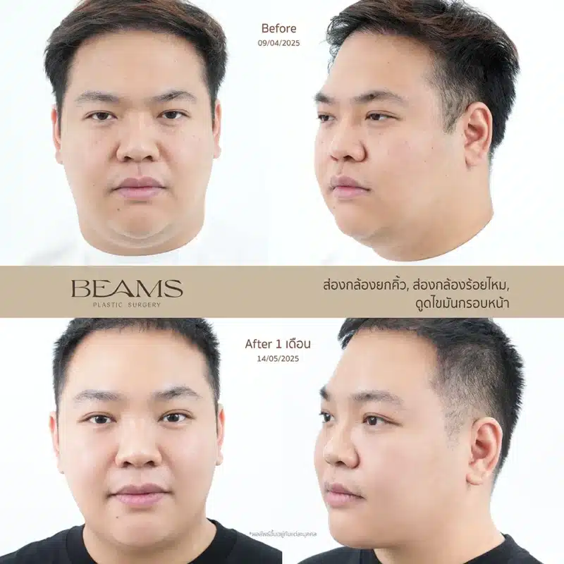 เคสรีวิวยกคิ้ว ส่องกล้องผู้ชาย