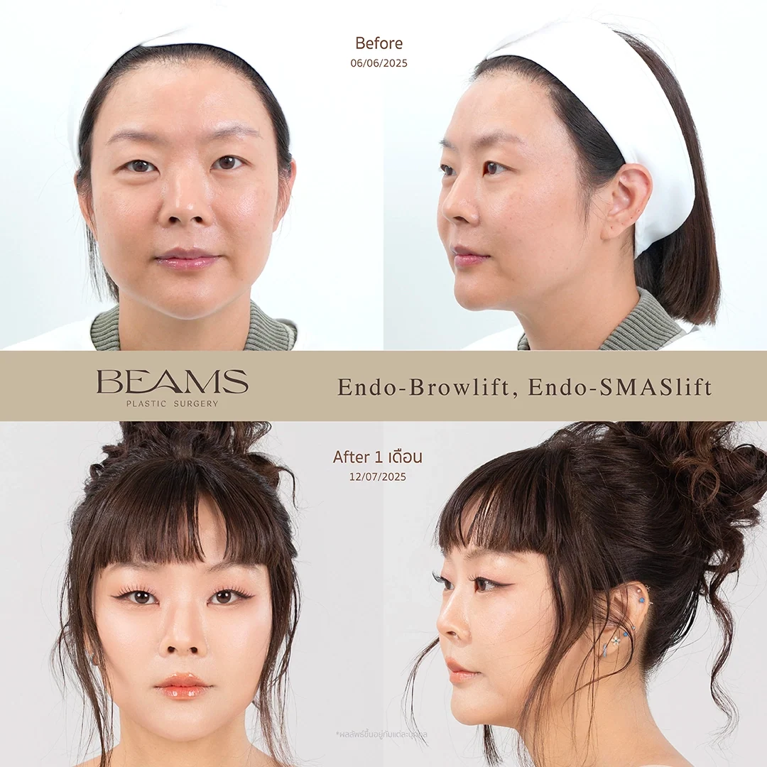 รีวิวหัตถการคุณลุลา