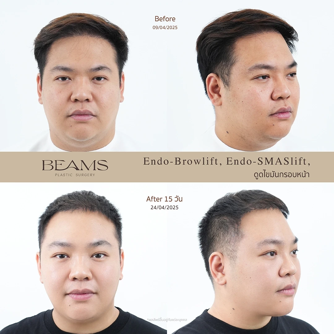 รีวิวคุณตี๋ ส่องกล้องยกคิ้ว , ส่องกล้องร้อยไหม,ดูดไขมันกรอบหน้า