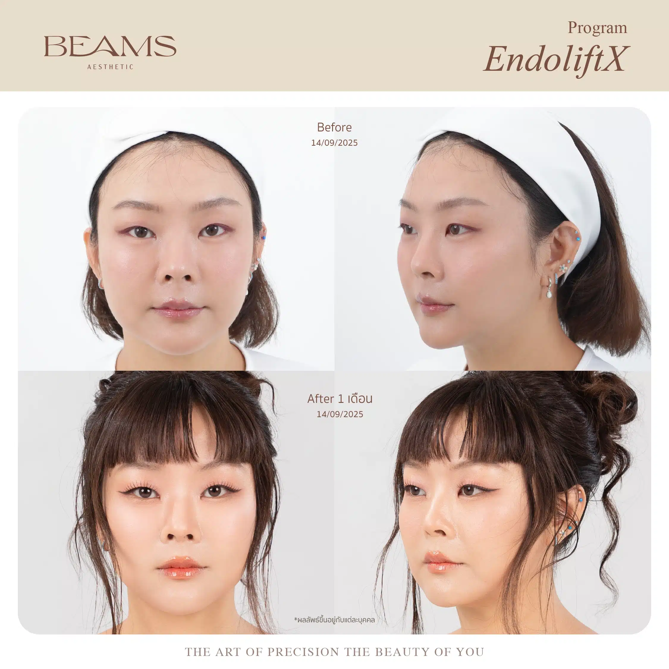 Endolift รีวิว