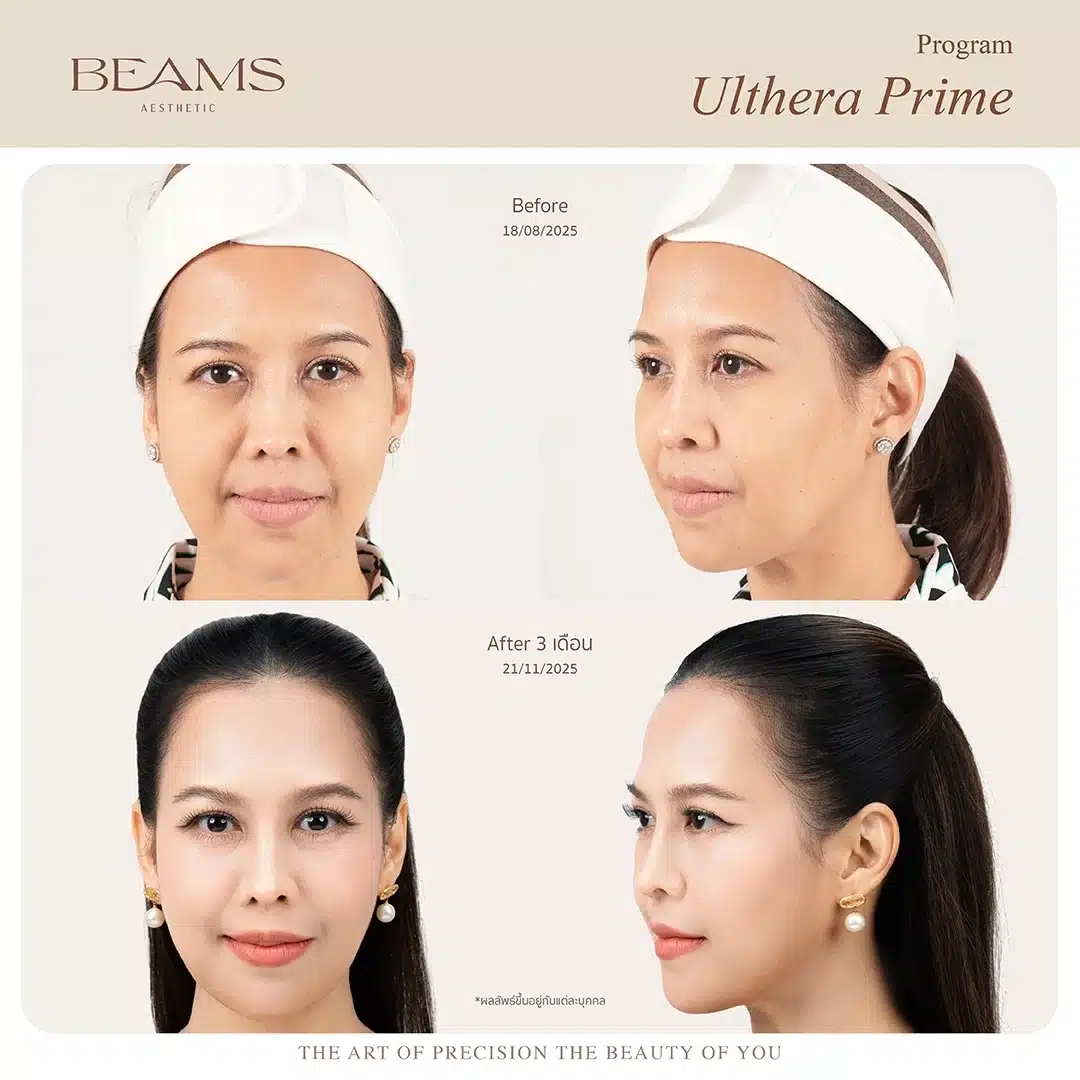 Ulthera รีวิว