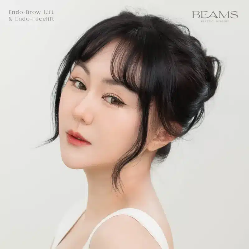 ข้อดีข้องส่องกล้องดึงหน้า ผลลัพธ์คุณอาเล็ค