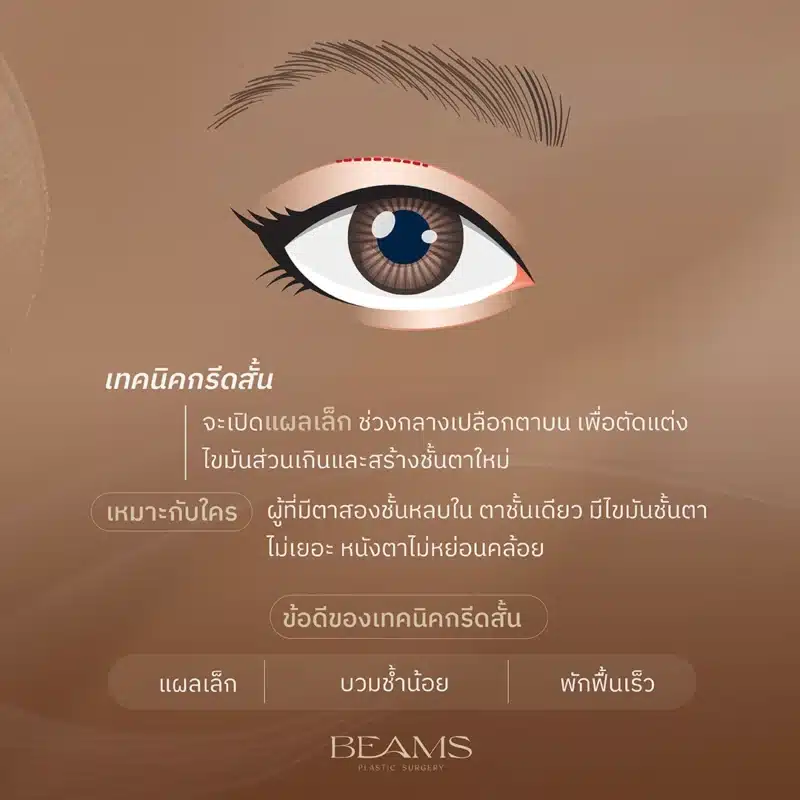 เทคนิคกรีดสั้น (Short incision)