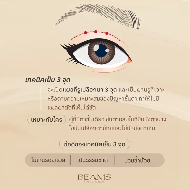 เทคนิคเย็บ 3 จุด