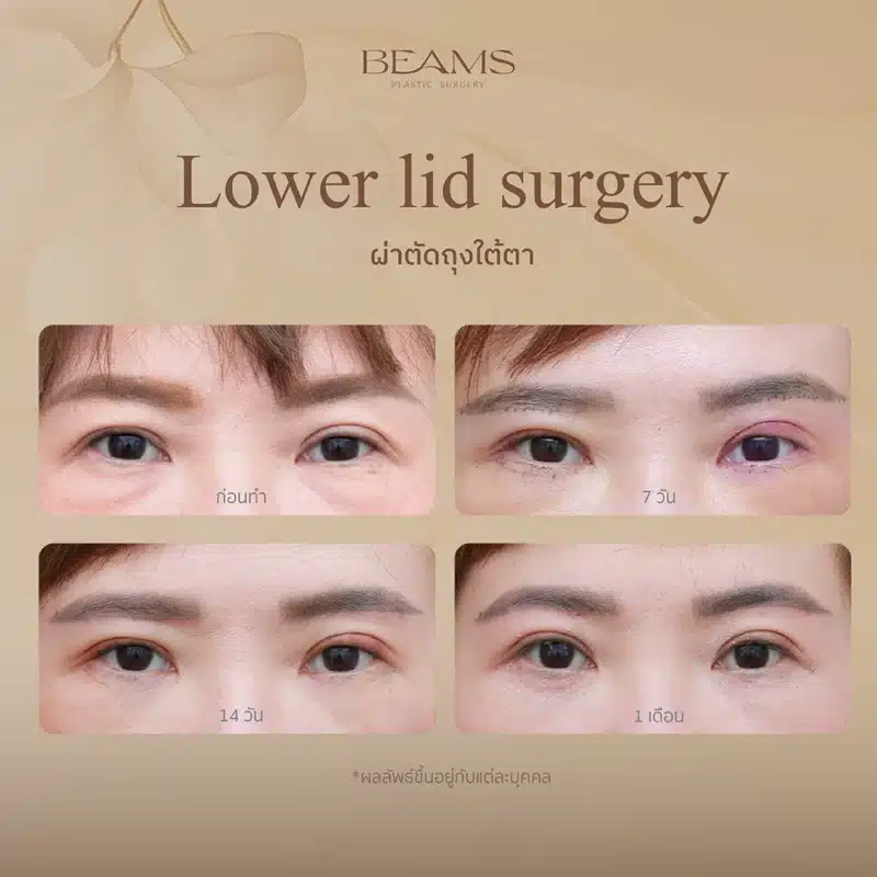 รีวิวผ่าตัดถุงใต้ตาแผลนอก