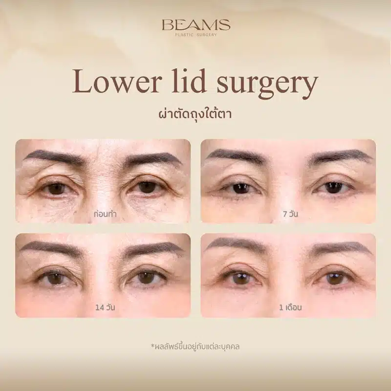 รีวิวผ่าตัดถุงใต้ตาแผลใน