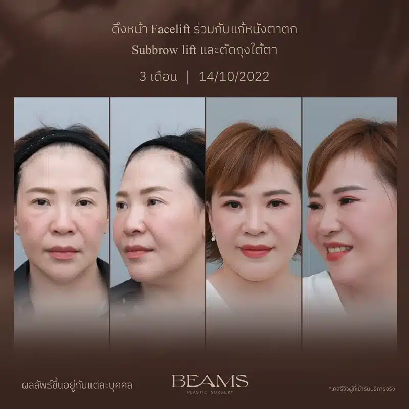 เคสรีวิวคุณเล็ก ผ่าตัดถุงใต้ตาล่าง