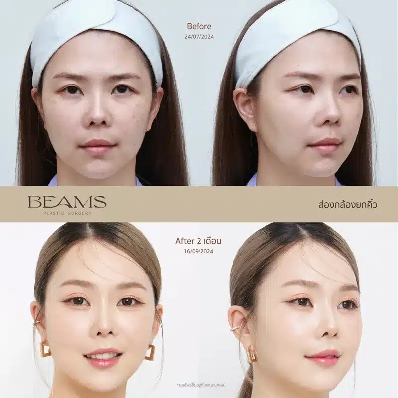 รีวิวยกคิ้ว ส่องกล้อง