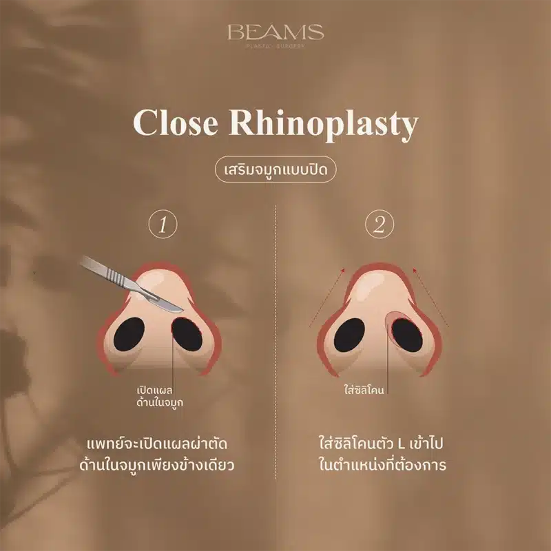 การเสริมจมูกแบบปิด