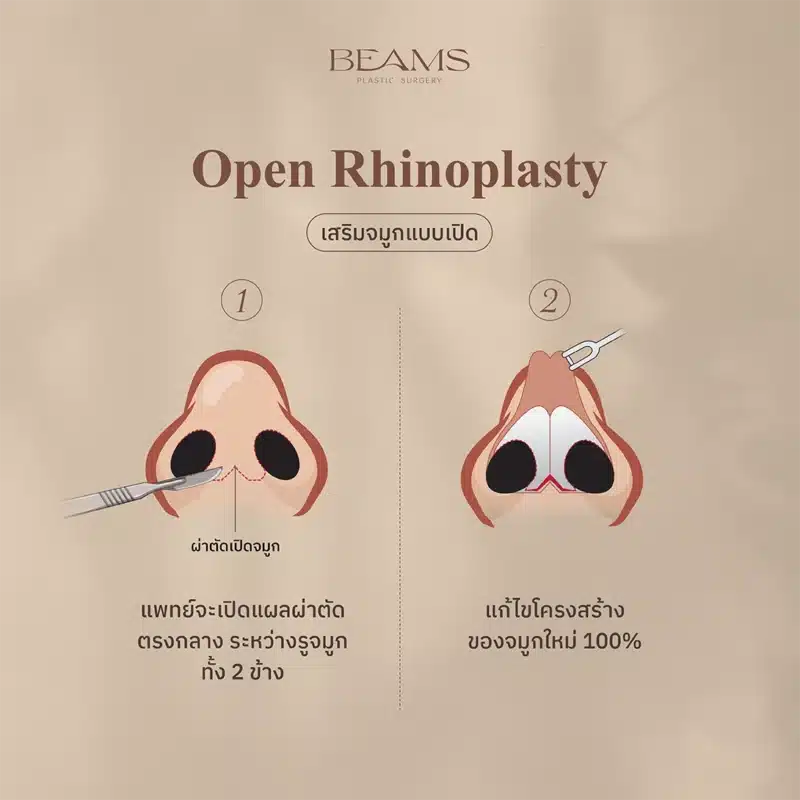 การเสริมจมูกแบบเปิด
