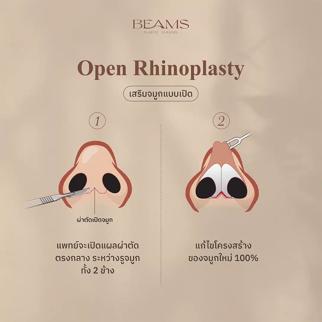 การเสริมจมูกแบบเปิด