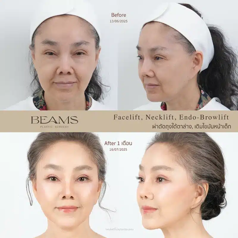 รูปรีวิวศัลยกรรมคอ