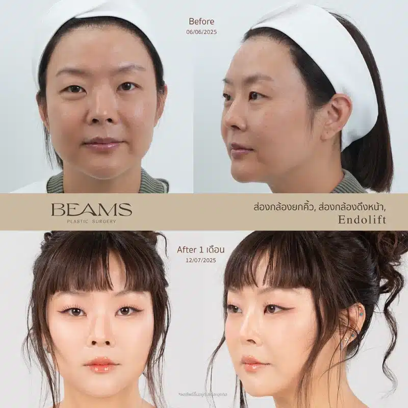 รีวิวหัตถการคุณลุลา