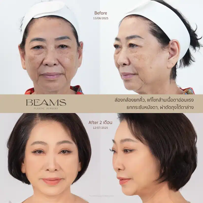 รีวิวเคสกล้ามเนื้อตาอ่อนแรง - เคสคุณทิพวรรณ