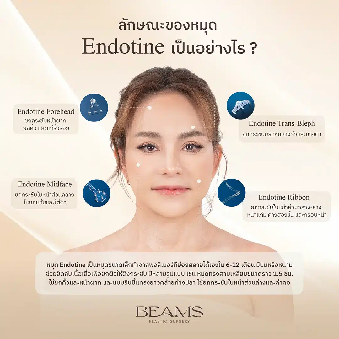 รวมลักษณะหมุด Endotine