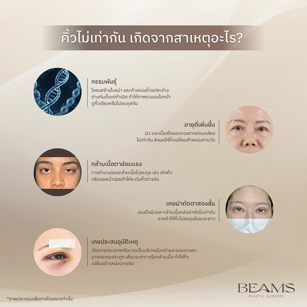 สาเหตุคิ้วไม่เท่ากัน