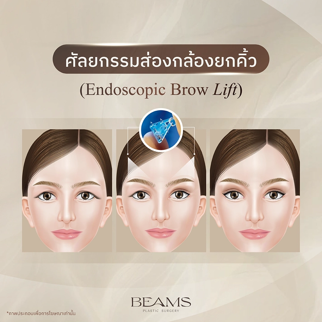 การยกคิ้วส่องกล้อง