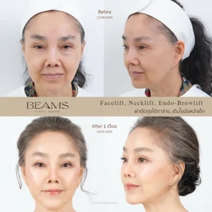 รีวิวดึงหน้า