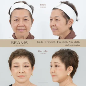 ผ่าตัดดึงหน้า รีวิว