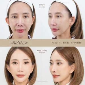 แชร์ประสบการณ์ดึงหน้า