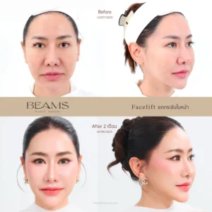 รีวิวผ่าตัดดึงหน้า