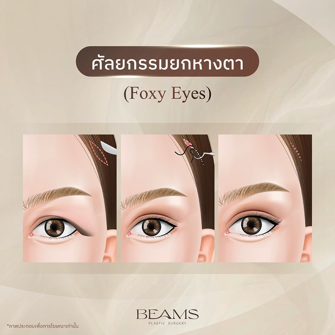 การยกหางตา