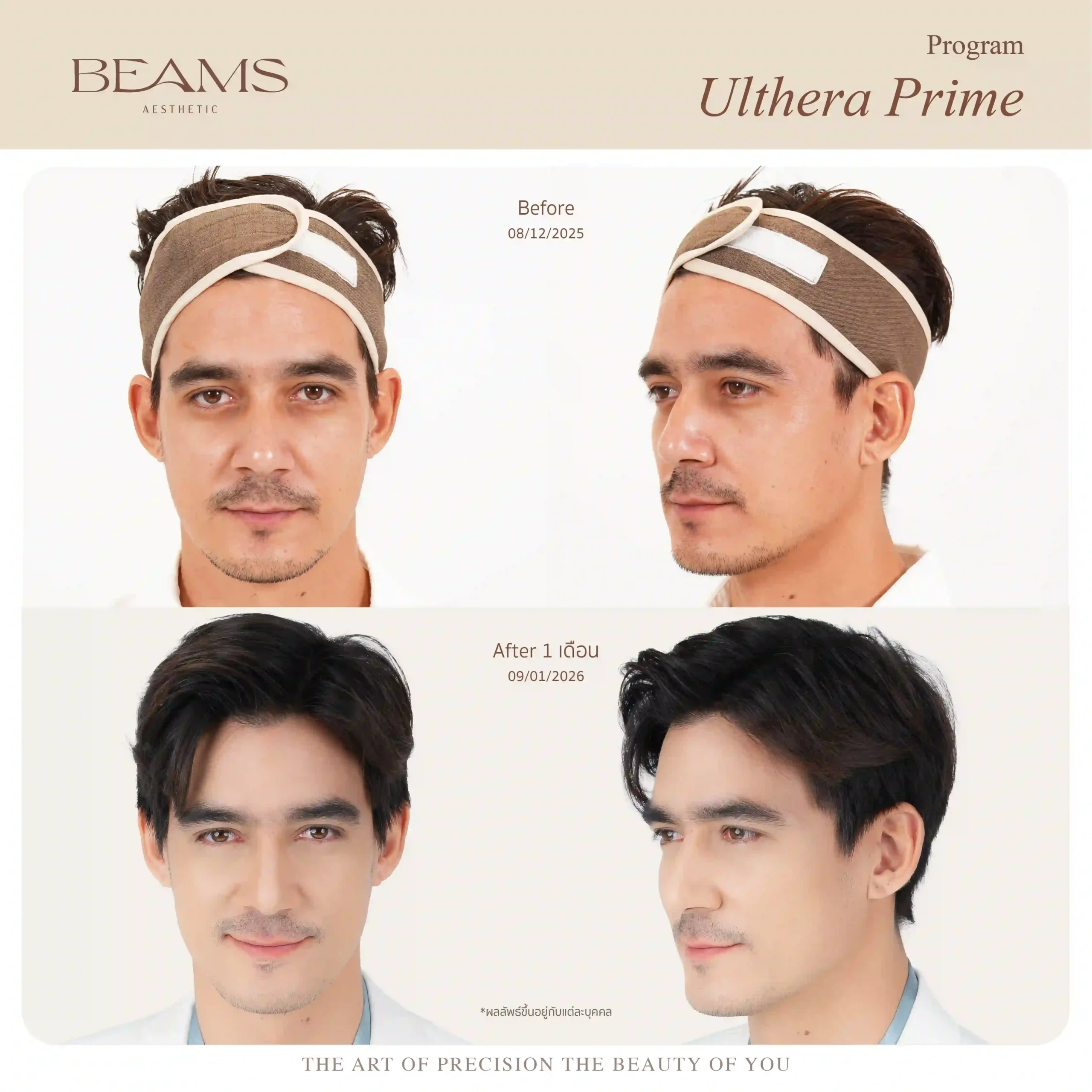 รีวิว ultherapy prime