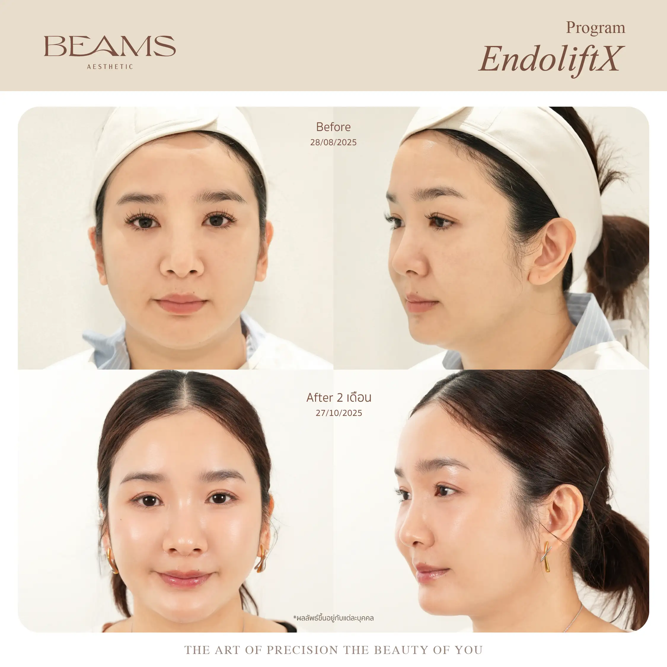 รีวิวทำ ultherapy prime