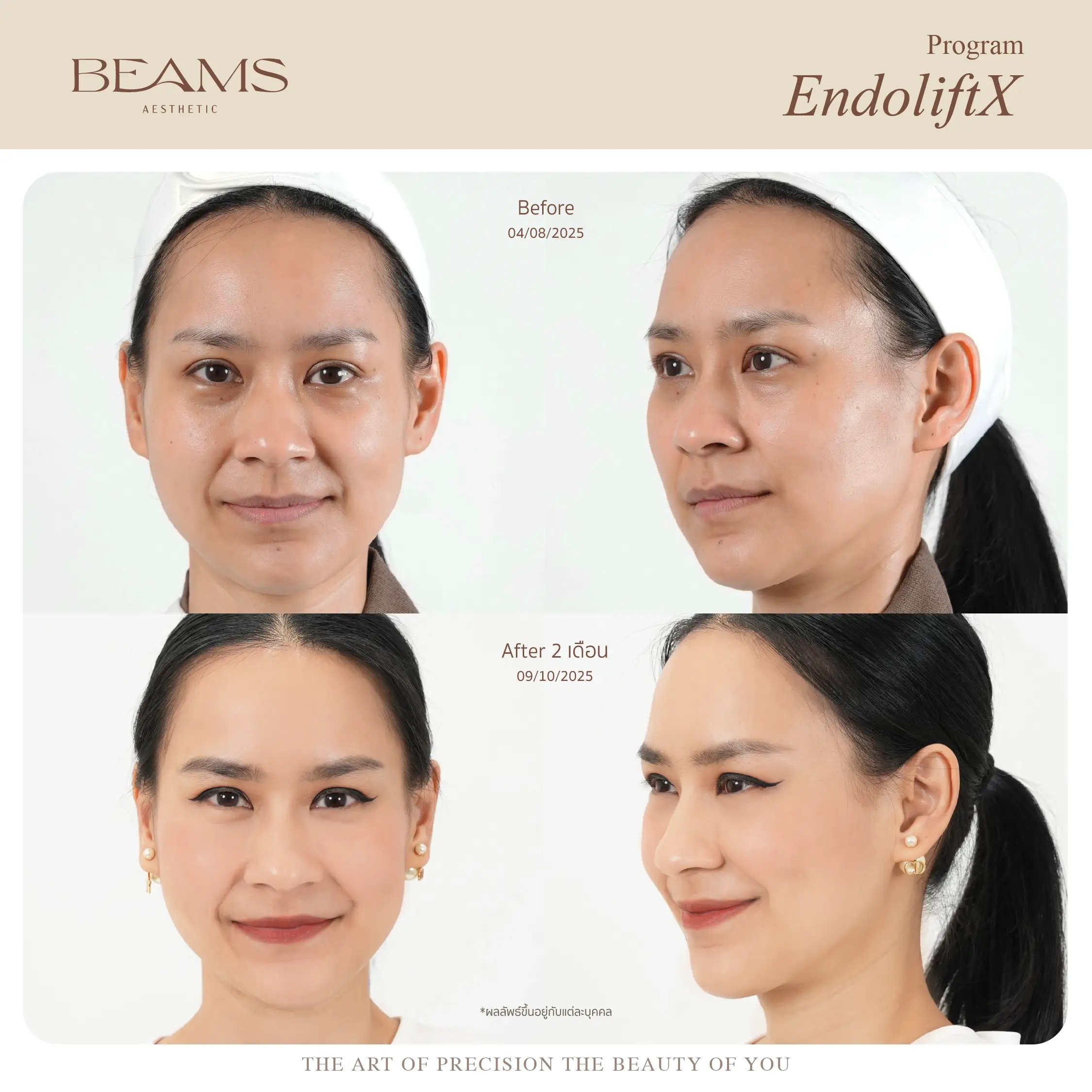 รีวิวก่อน-หลังทำ ultherapy prime