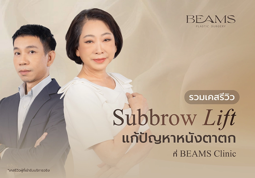 Subbrow Lift รีวิว