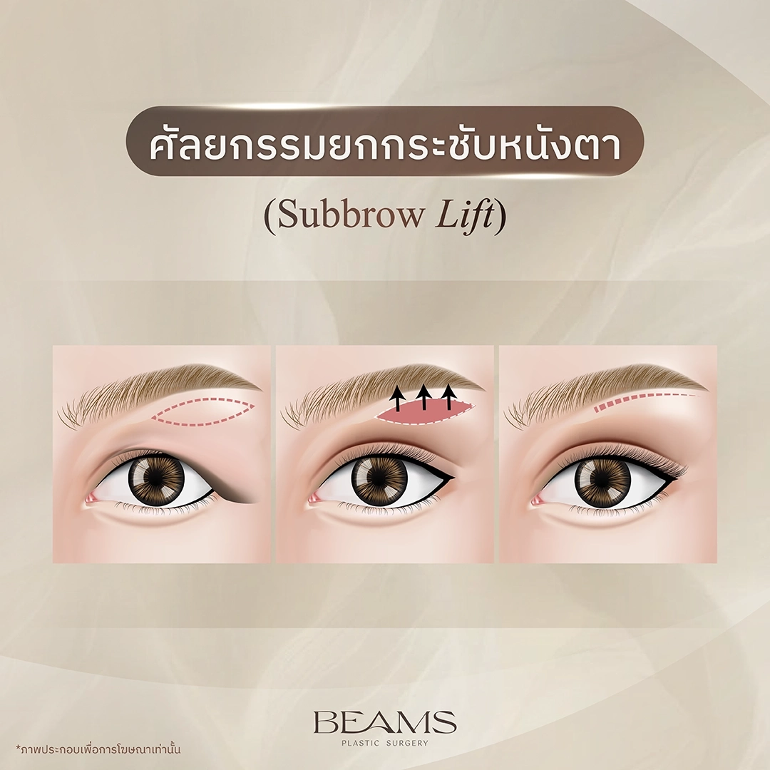 การยกกระชับหนังตา