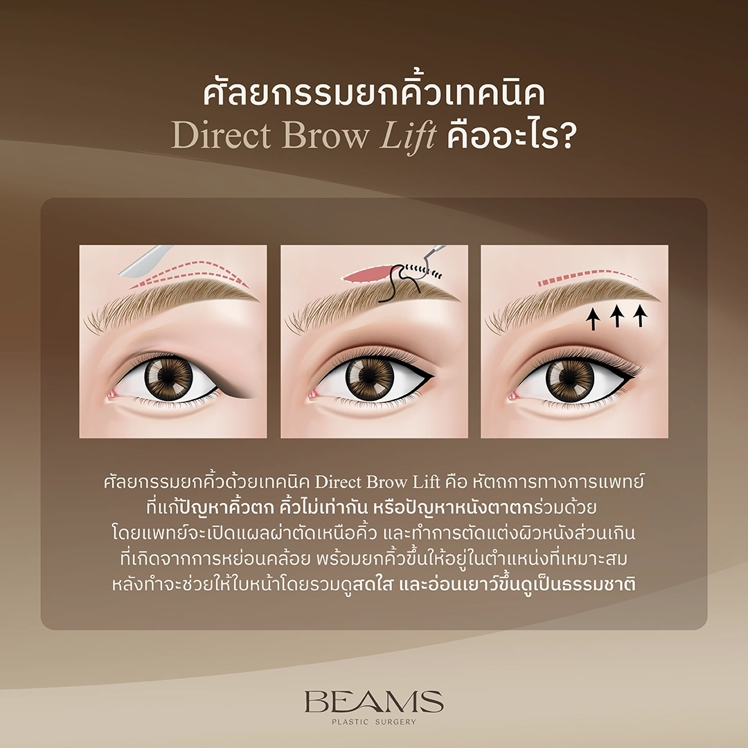 direct brow lift คืออะไร