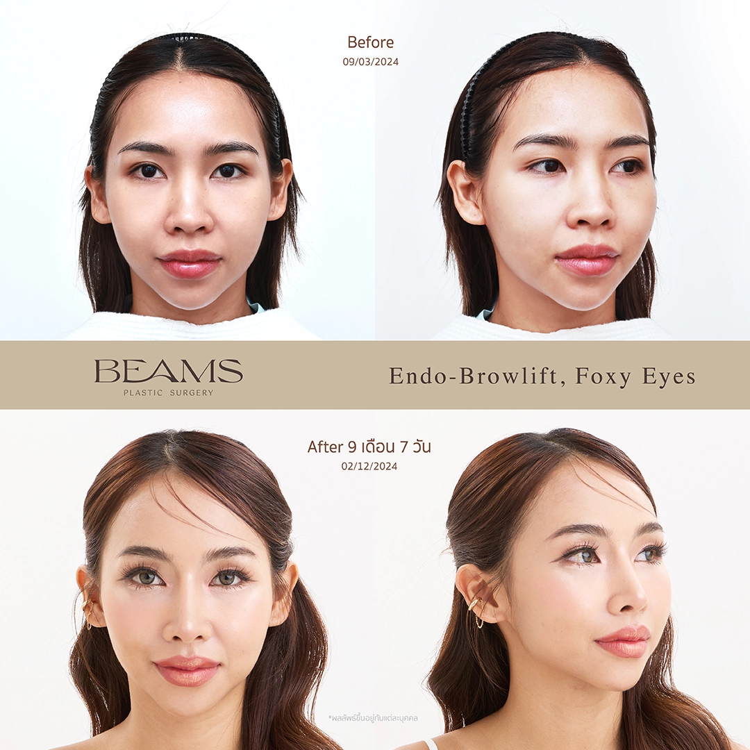 รีวิวคุณฟี่ Endo Brow-Lift