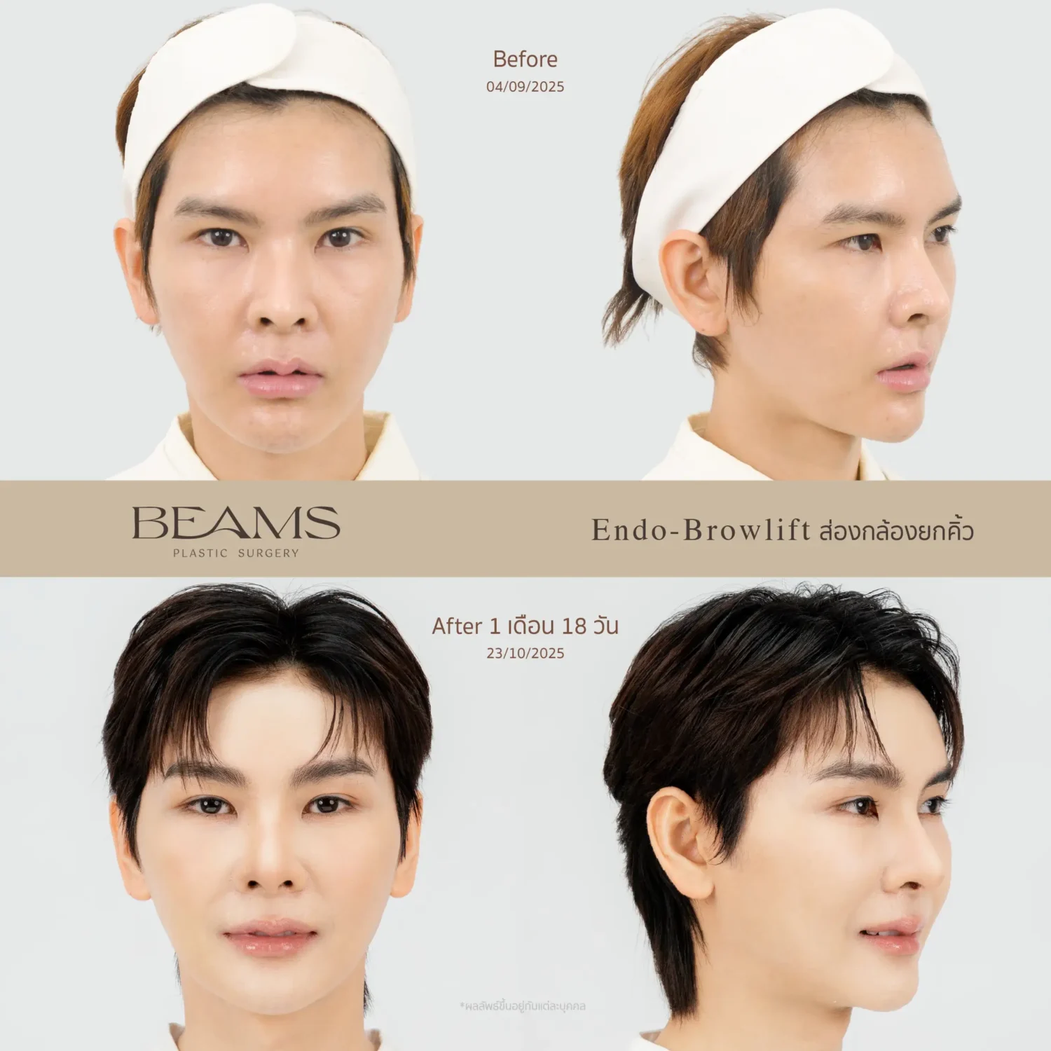 รีวิวยกคิ้ว endotine