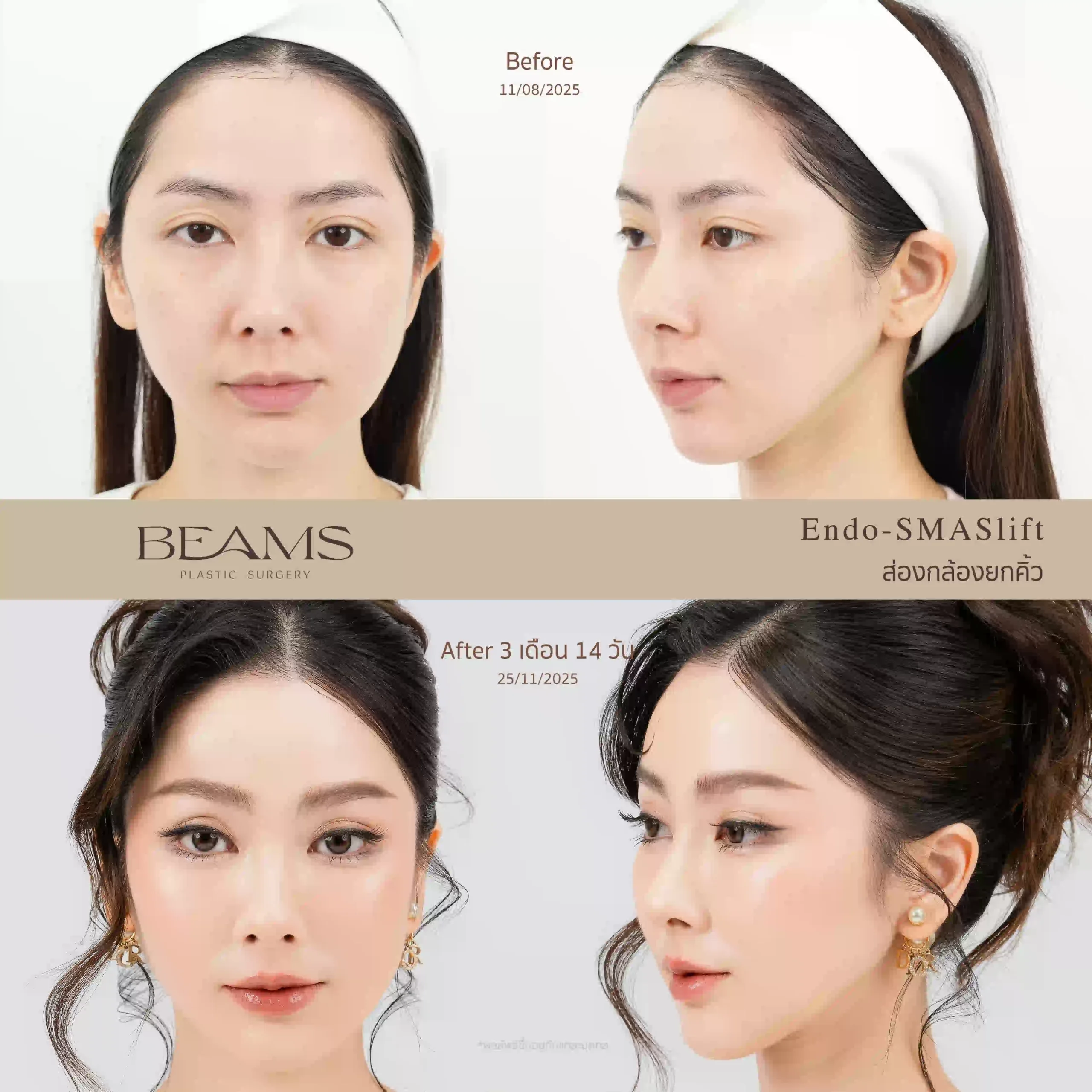 รีวิวยกคิ้ว Endotine