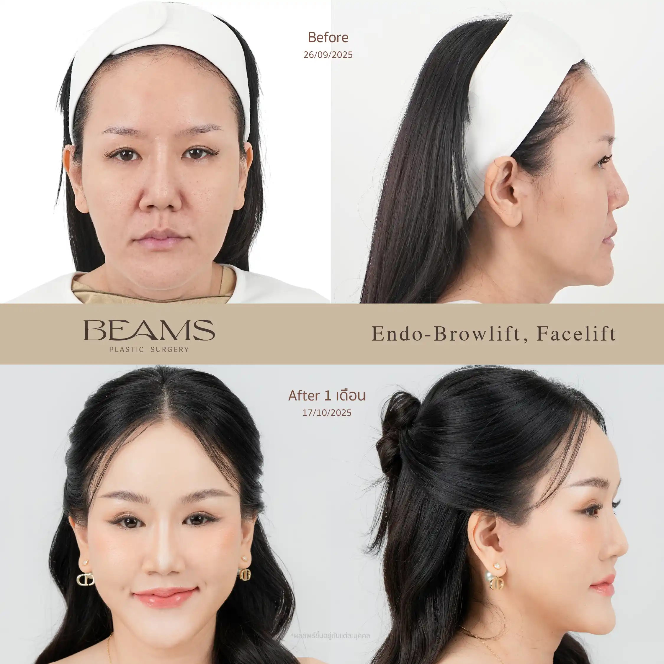 รีวิวดึงหน้า