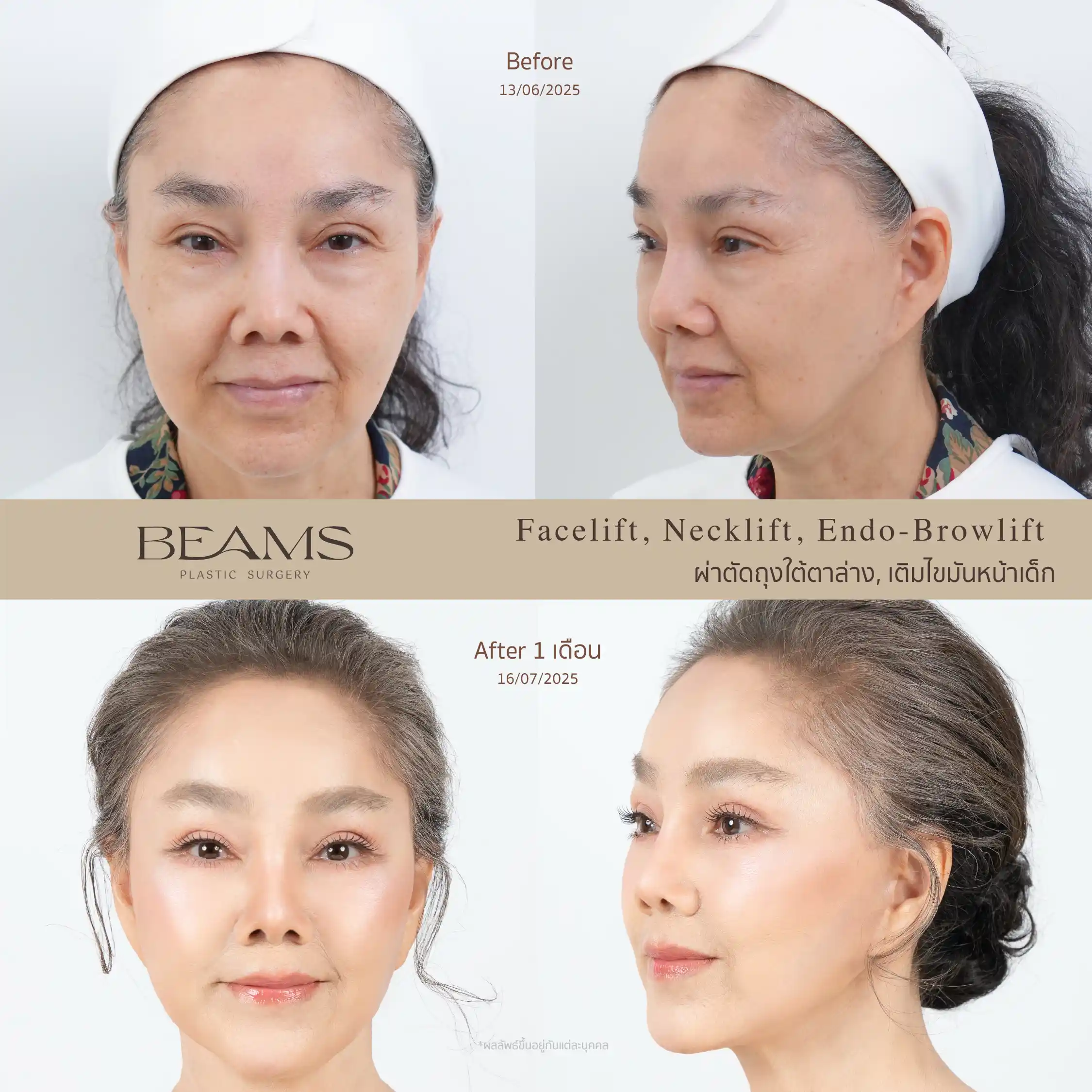 รีวิวดึงหน้า