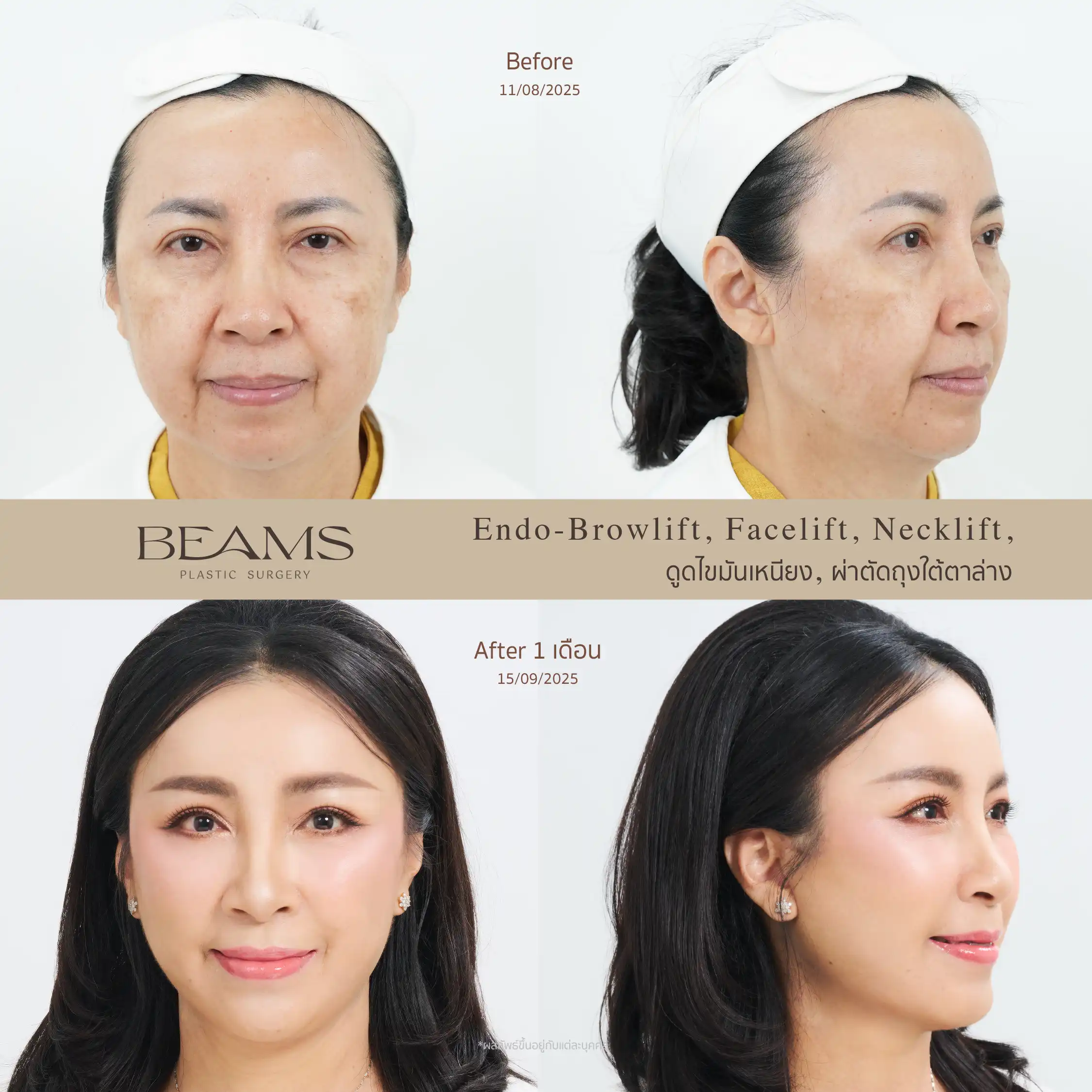 รีวิวดึงหน้า