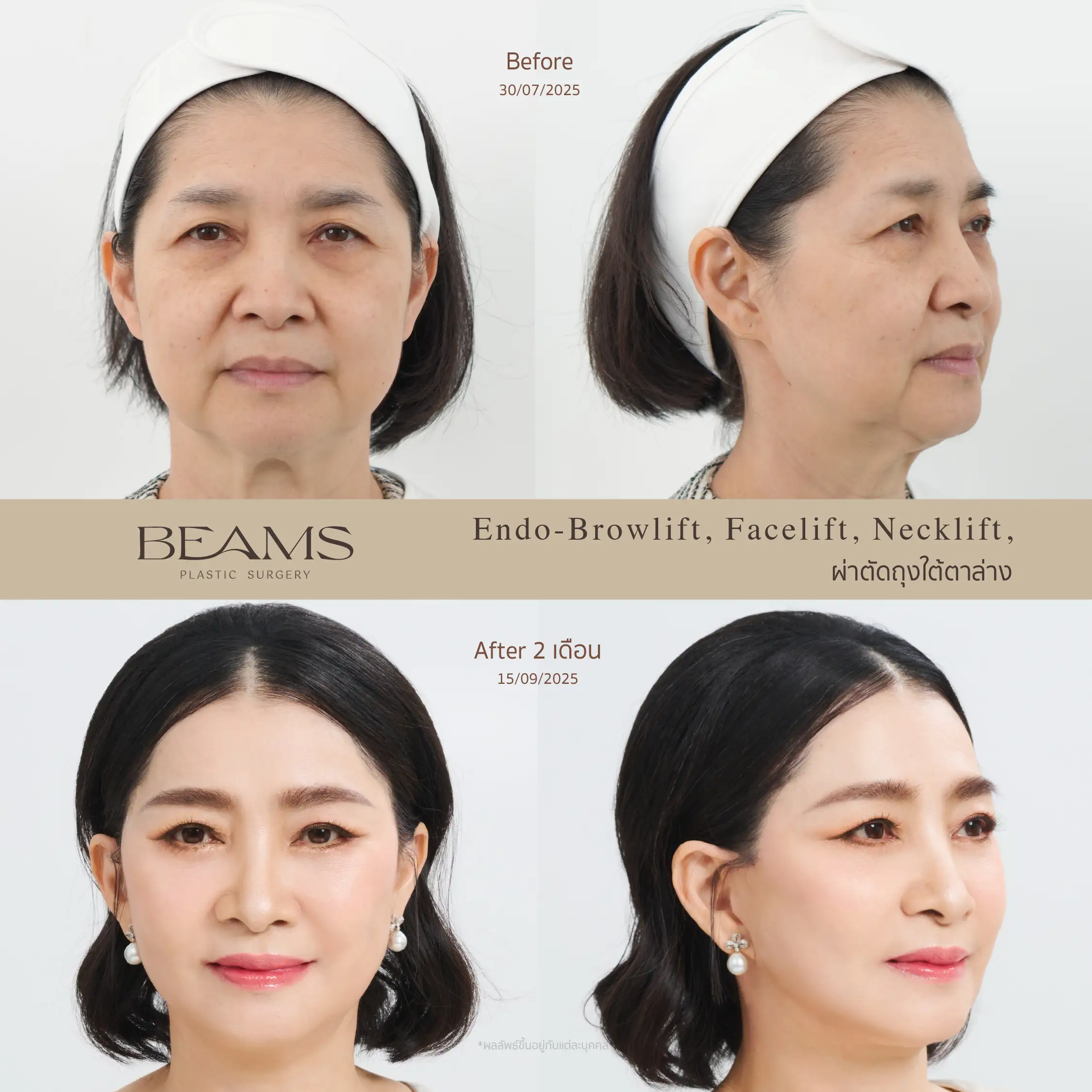 รีวิวดึงหน้า