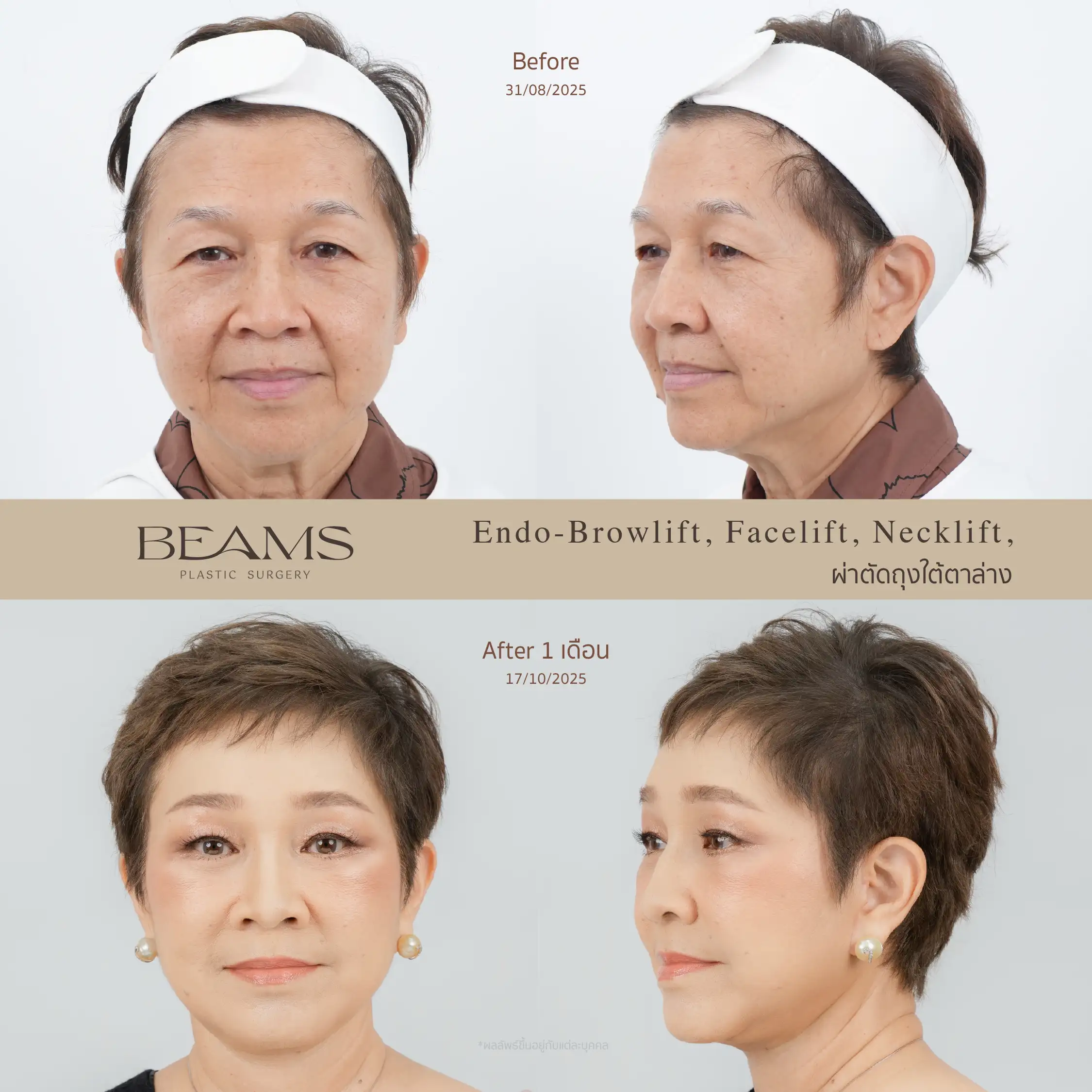 รีวิวดึงหน้า