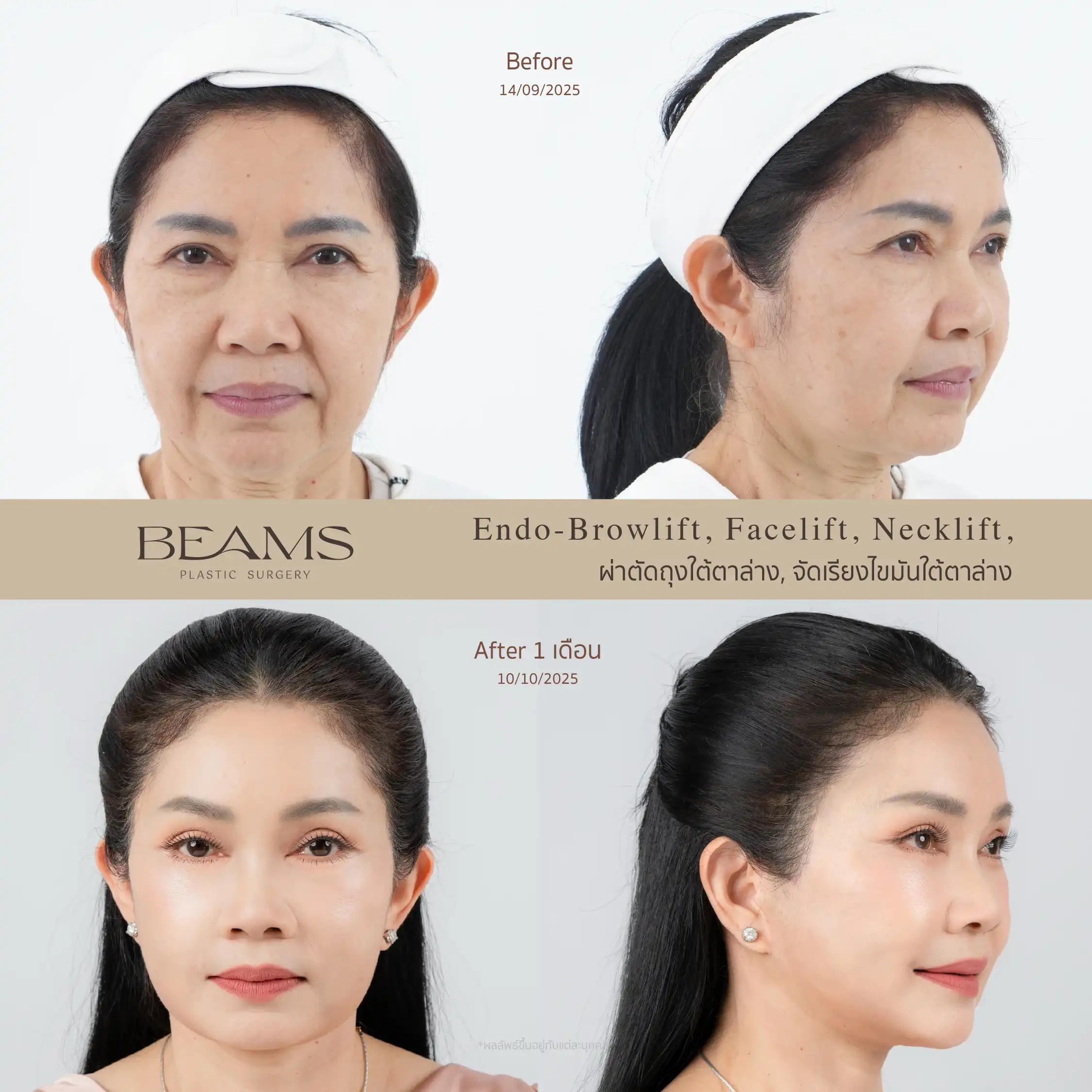 รีวิวดึงหน้า