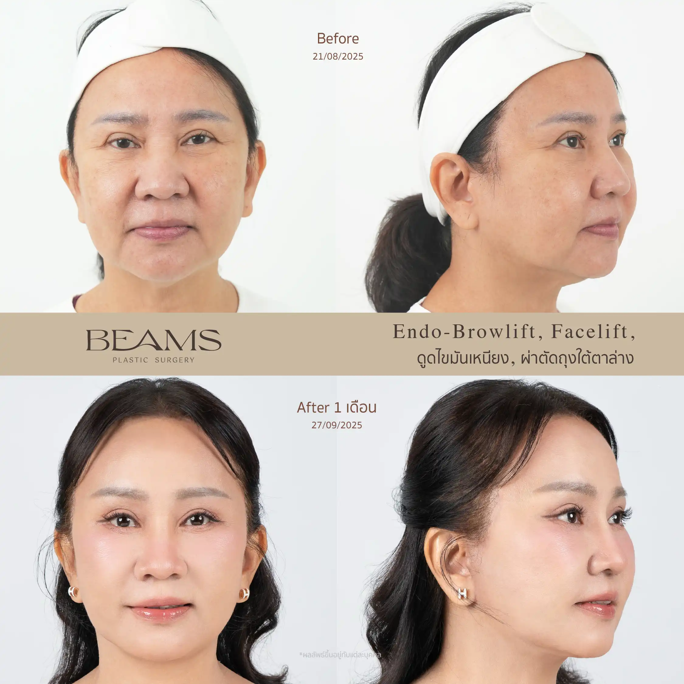 รีวิวดึงหน้า